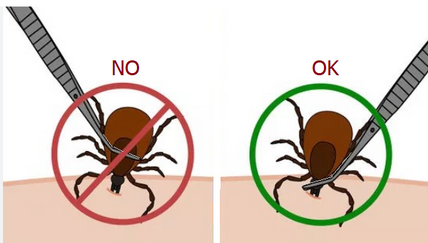 Illustrazione di come togliere una zecca con una pinzetta